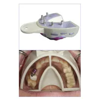 CUBETAS MIRATRAY IMPLANT INFERIOR MEDIANA